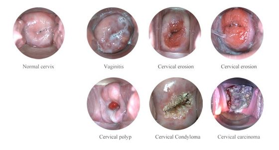 Vaginal Camera for Women Care Digital Mini Colposcope 1.5 Times Magnification 10cm Observation Distance